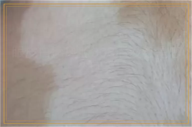 眼皮白癜风照308后没红是怎么回事