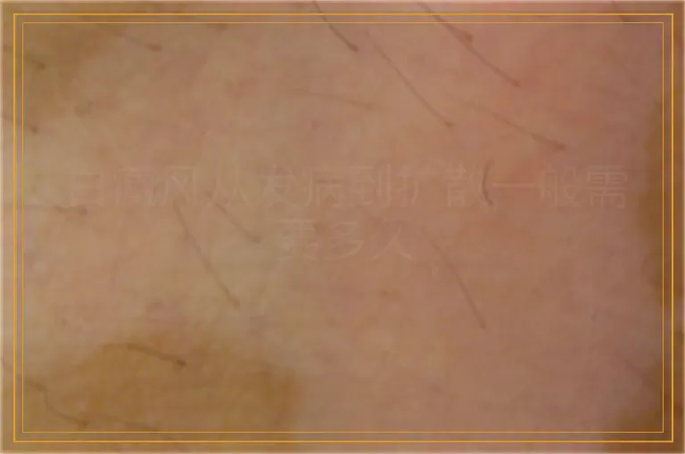 白癜风从发病到扩散一般需要多久