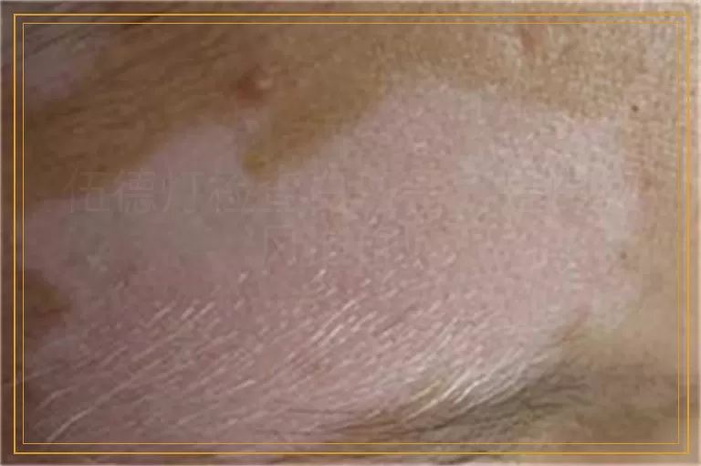 伍德灯检查白斑是不是白癜风准确吗