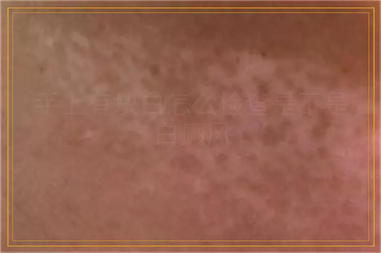 手上有块白怎么检查是不是白癜风