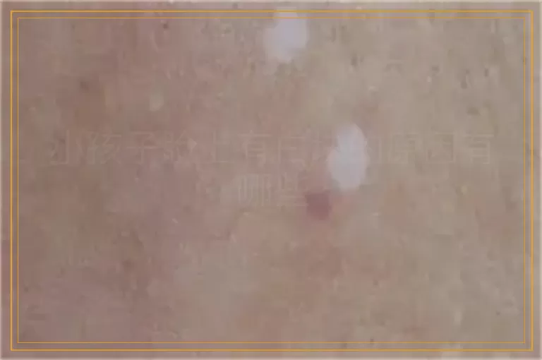 小孩子脸上有白块的原因有哪些