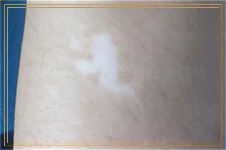 白癜风能不能阻断母婴遗传