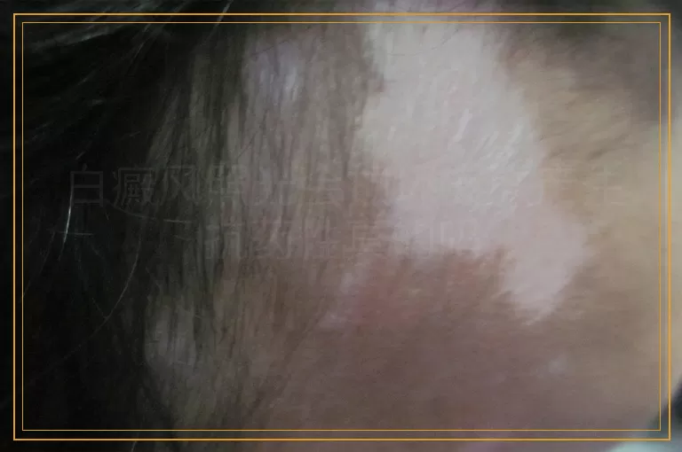白癜风照光会损坏皮肤产生抗药性真的吗