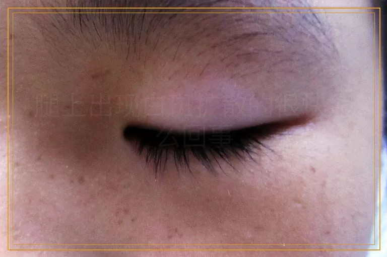 腿上出现白斑扩散的很快怎么回事