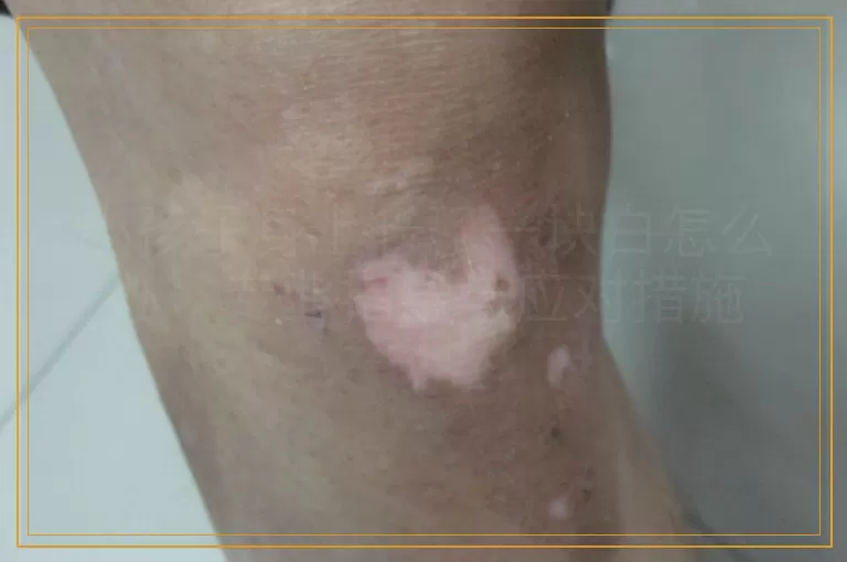 小孩子身上长了一块白怎么办：专业指导与应对措施