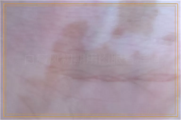 白癜风初期用肉眼看准吗