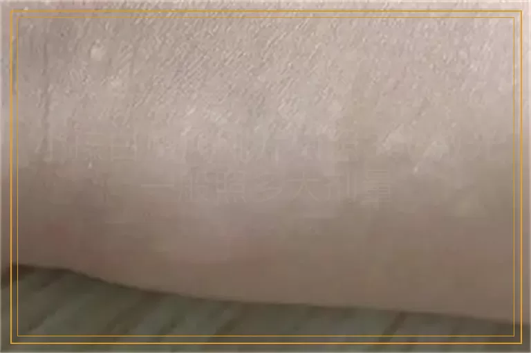 小孩白癜风刚开始照308激光一般照多大剂量