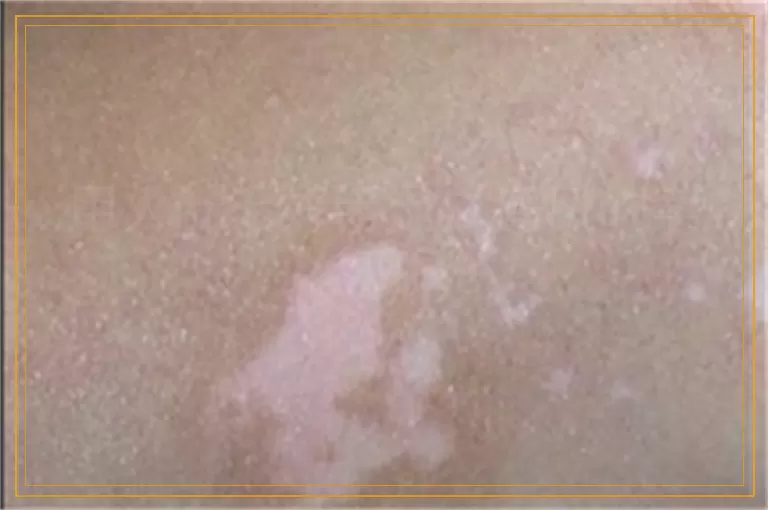 用火针治好手上白癜风的案例