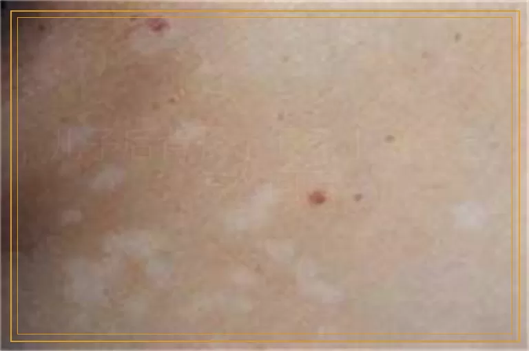 儿子后背长了很多小白点是怎么回事