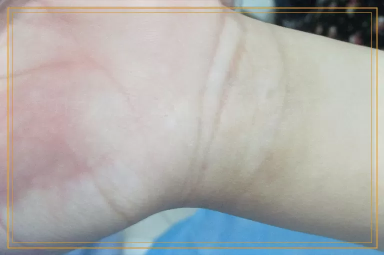 为什么腿上有白点点是白癜风吗