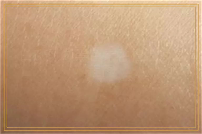 白癜风做黑色素种植治疗过程图