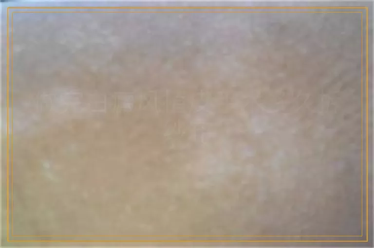 做完白癜风植皮手术多久拆纱布