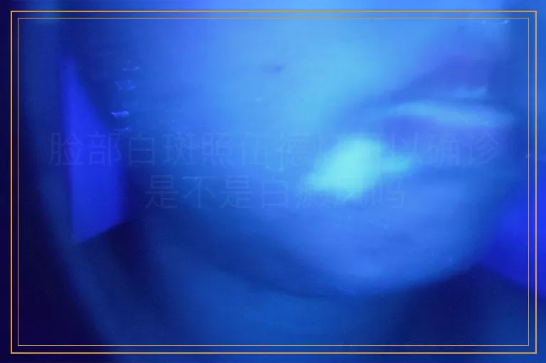 脸部白斑照伍德灯可以确诊是不是白癜风吗