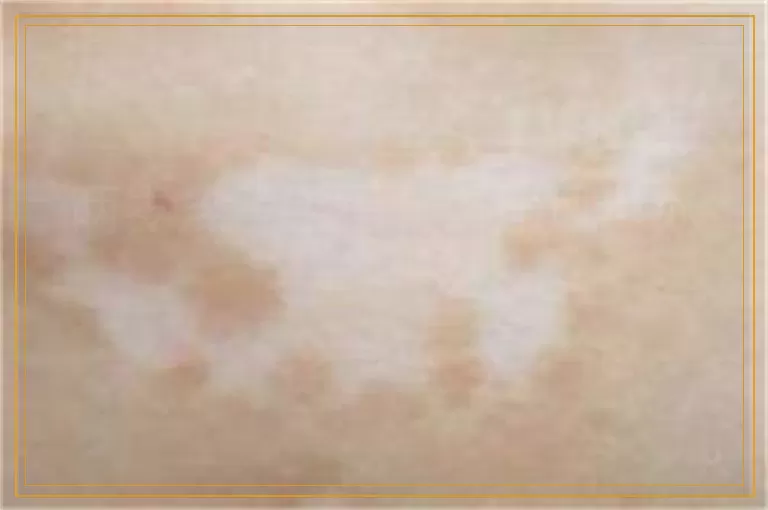 两岁孩子手指有白癜风可以治好吗