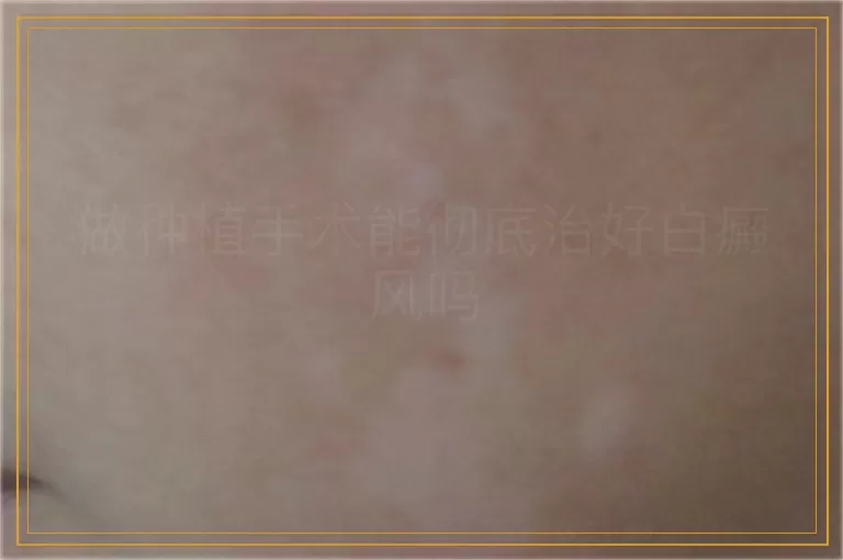 做种植手术能彻底治好白癜风吗