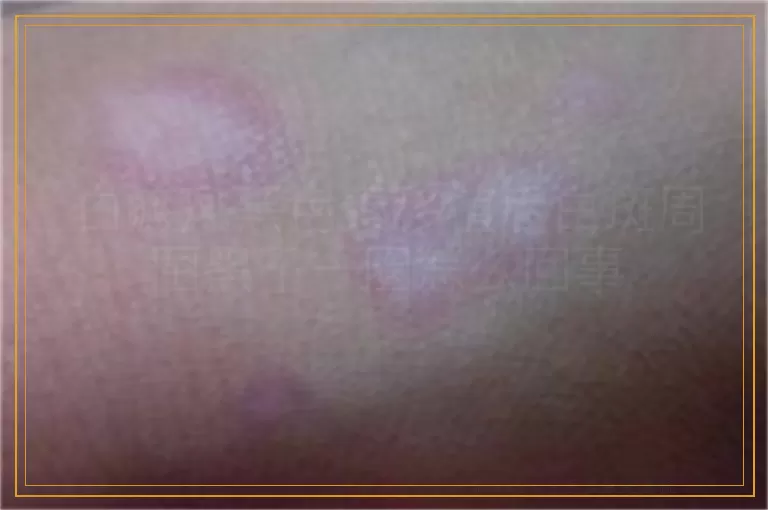 白癜风黑色素移植后白斑周围黑了一圈怎么回事