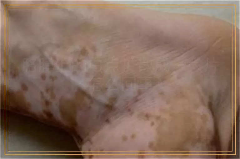 胳膊上的白点扩散成一大片怎么回事