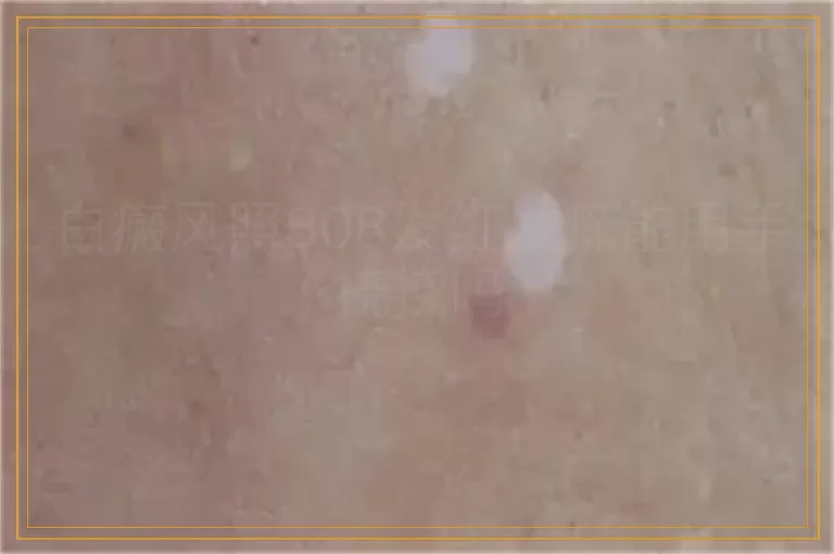 白癜风照308发红发痒能用手挠挠吗