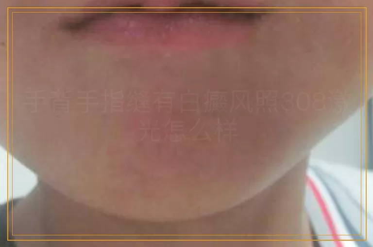 手背手指缝有白癜风照308激光怎么样