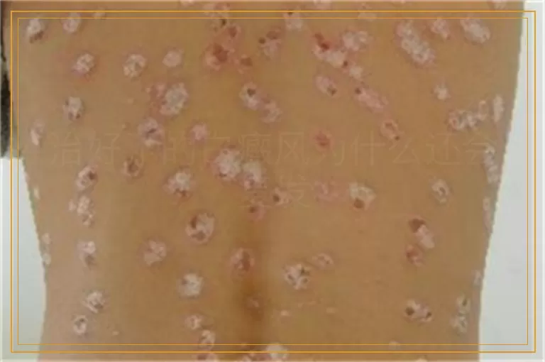 治好了的白癜风为什么还会复发