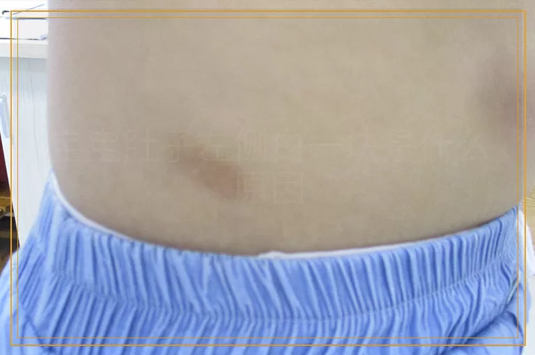 宝宝肚子左侧白一块是什么原因