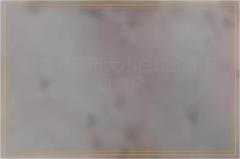 颈部有硬币大小白斑是不是白癜风