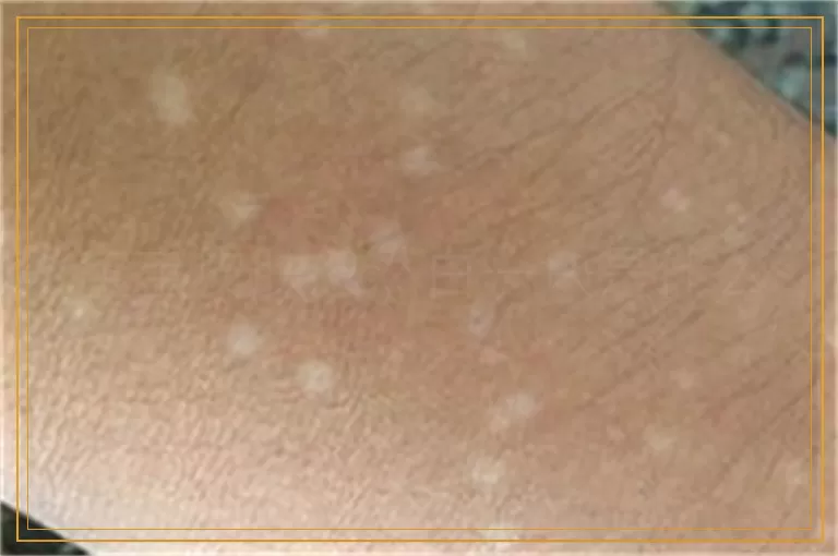 宝宝皮肤忽然白一块是什么