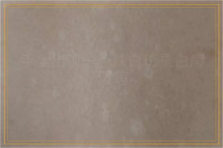 手上出现一小块白斑是白癜风吗
