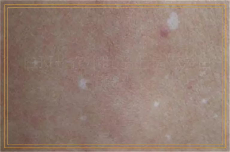 白斑长在小肚子上是不是白癜风