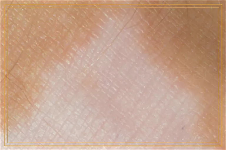 脸部白癜风植皮手术效果图