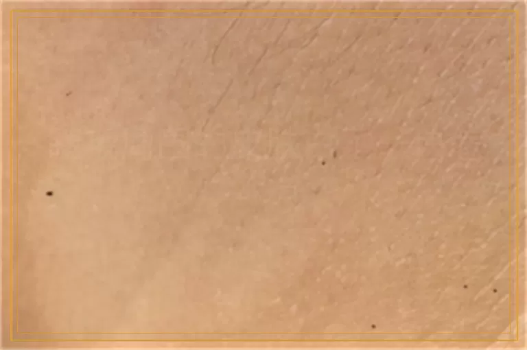 睫毛周围的皮肤白了一块怎么治