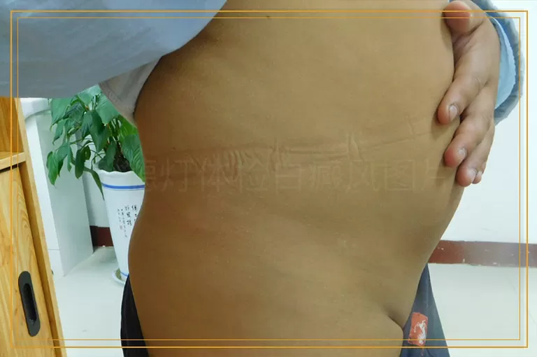 伍德灯体检白癜风图片