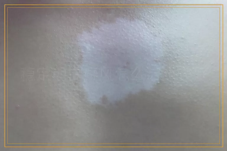 稳定期白癜风怎么治比较好