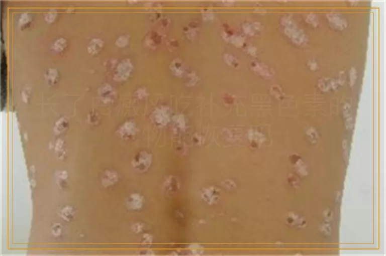 长了白癜风吃补充黑色素的食物能恢复吗