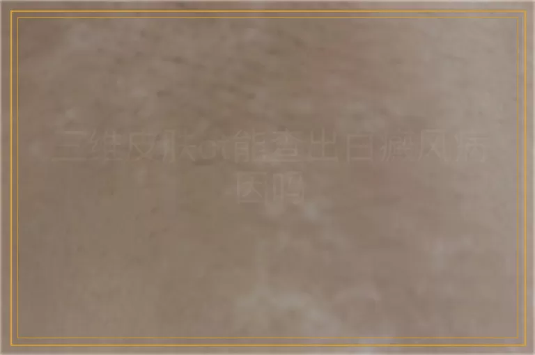 三维皮肤ct能查出白癜风病因吗