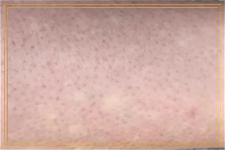 后天长的白癜风是什么原因引起的