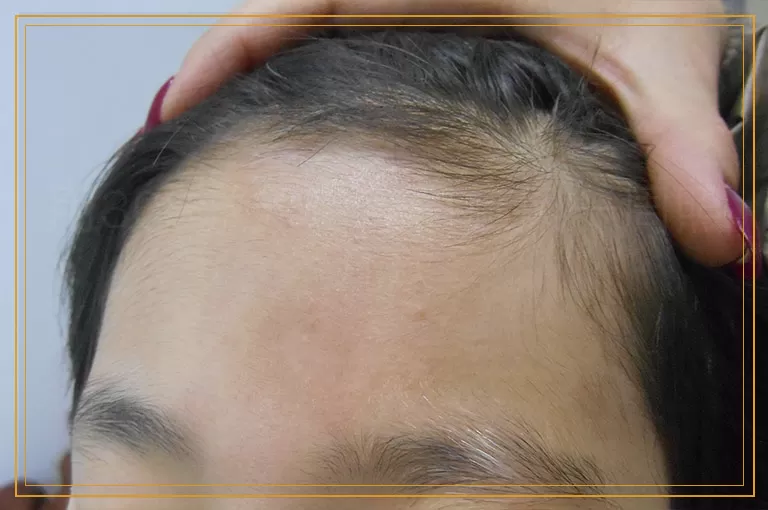 用308激光治疗白癜风一周照几次