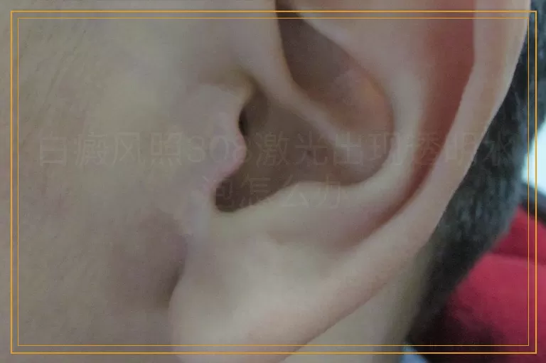 白癜风照308激光出现透明水泡怎么办