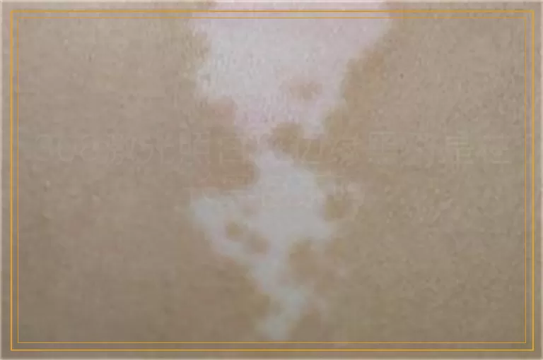 308激光照白斑边缘黑了是在长黑色素吗