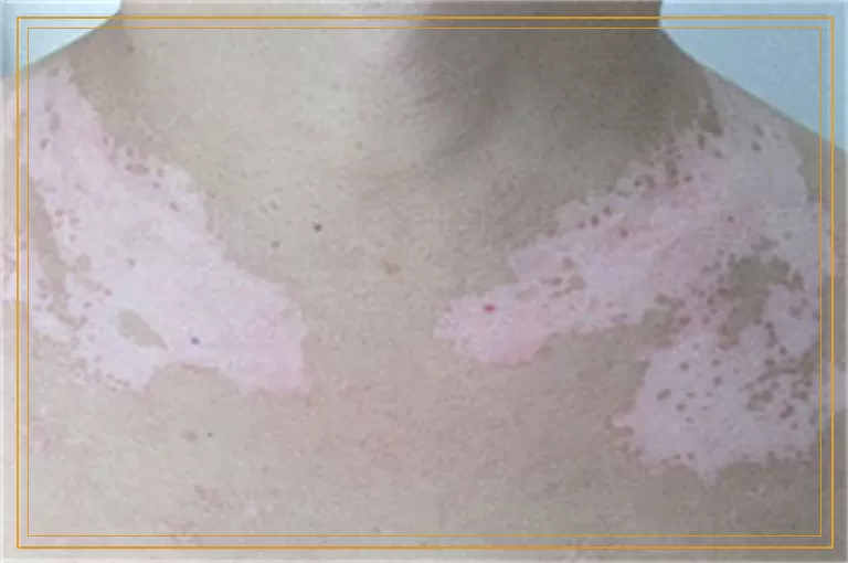 白癜风做308激光皮肤变黑表示有效果吗