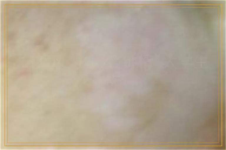 白癜风为什么“钟情”大学生呢