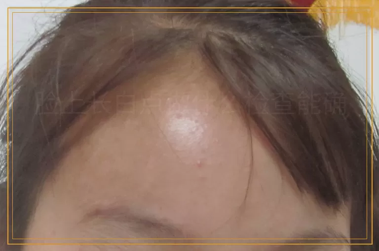 脸上长白点做什么检查能确诊