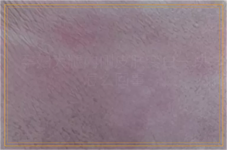 孕妇大腿内侧皮肤变白一块怎么回事