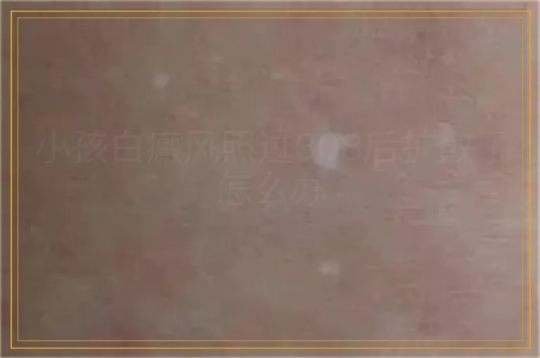 小孩白癜风照过308后扩散了怎么办