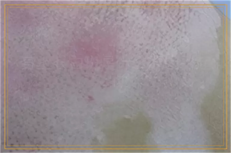 身上长白斑是什么原因引起的