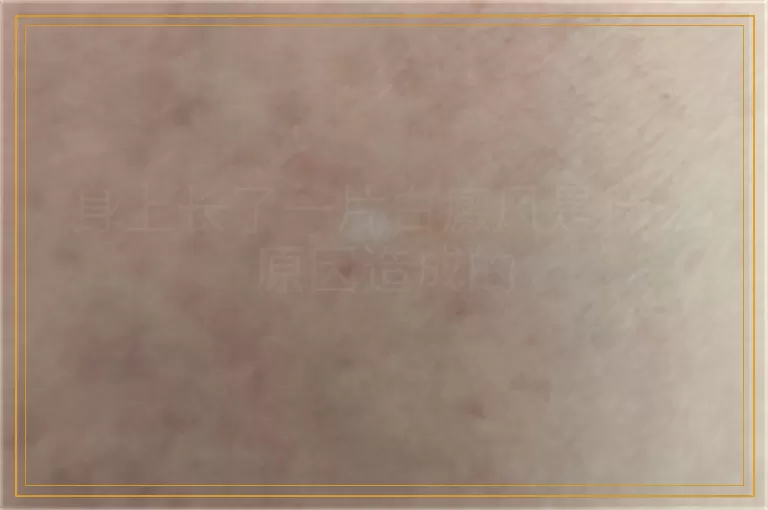 身上长了一片白癜风是什么原因造成的