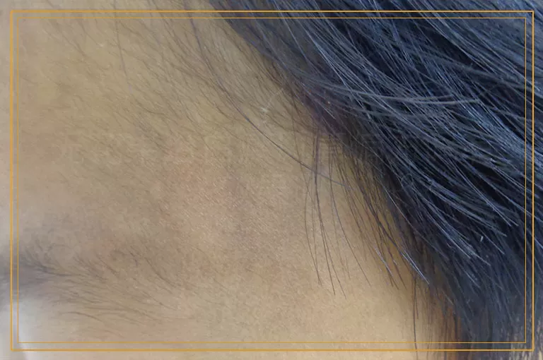 无花果治白癜风算偏方吗有效果吗