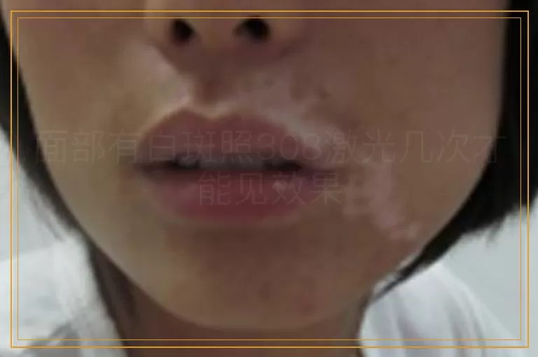 面部有白斑照308激光几次才能见效果