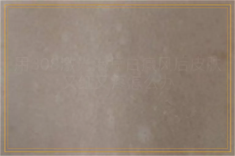 用308激光治疗白癜风后皮肤又红又疼怎么办