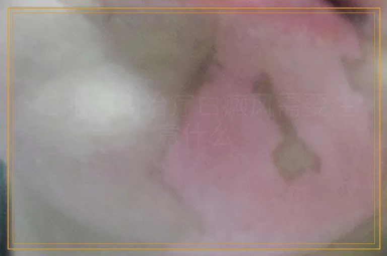 口服药物治疗白癜风需要注意什么